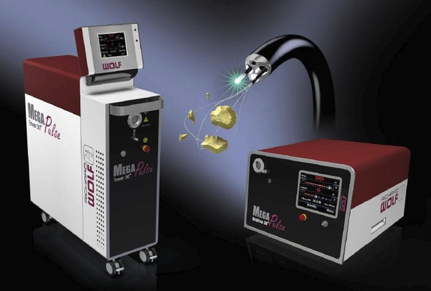 urology-ho-yag-laser-lithotripsy-78958-4434539